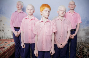 Brent Stirton. Niños ciegos y albinos en la India.